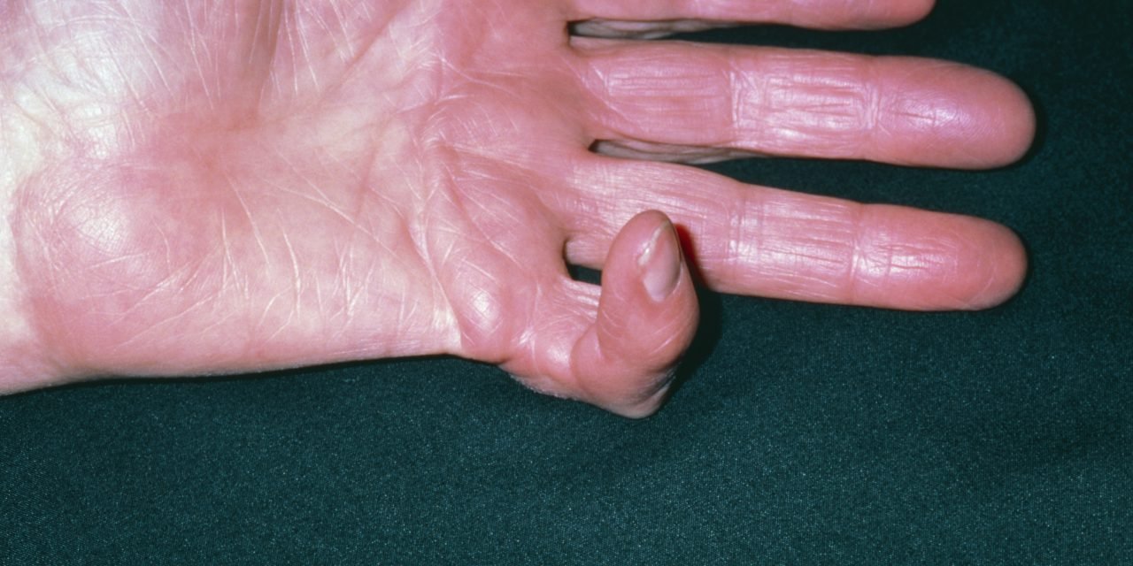 Causes and treatment of Dupuytren contracture