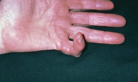 Causes and treatment of Dupuytren contracture