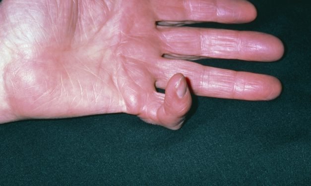 Causes and treatment of Dupuytren contracture