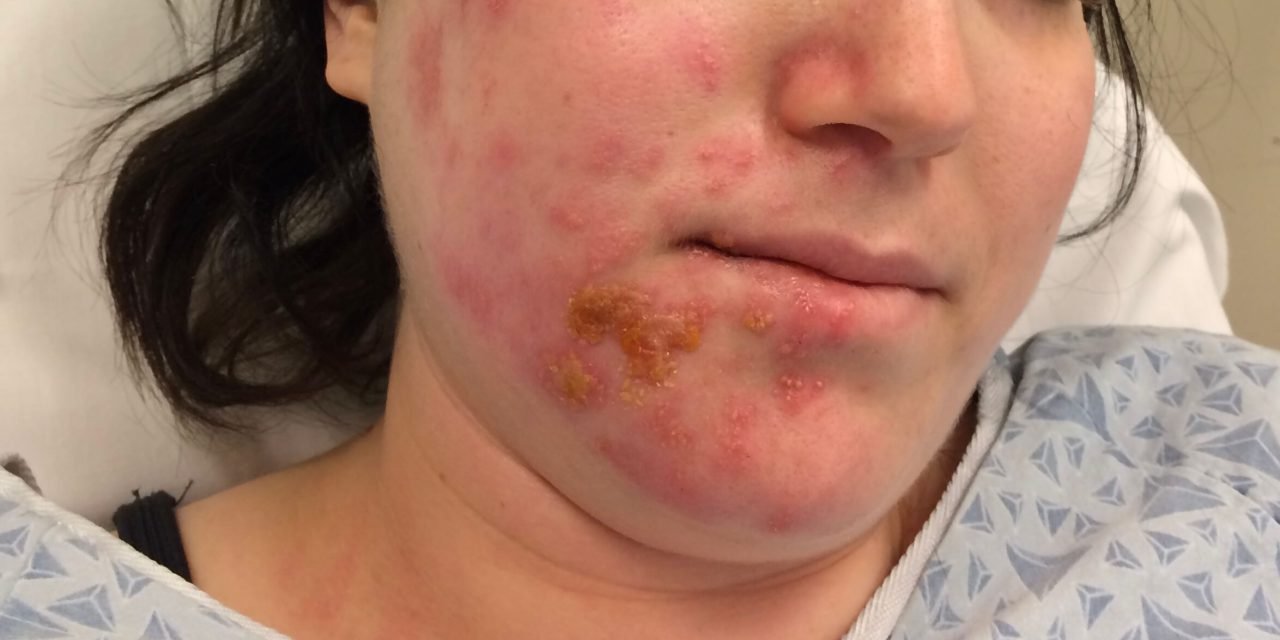 Symptoms and Causes of Ramsay Hunt Syndrome