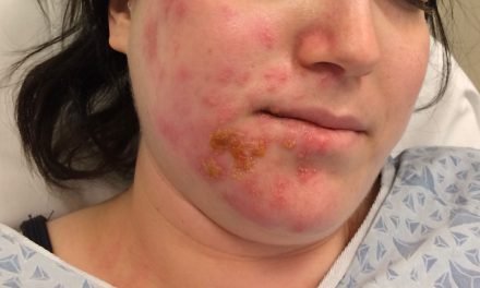 Symptoms and Causes of Ramsay Hunt Syndrome