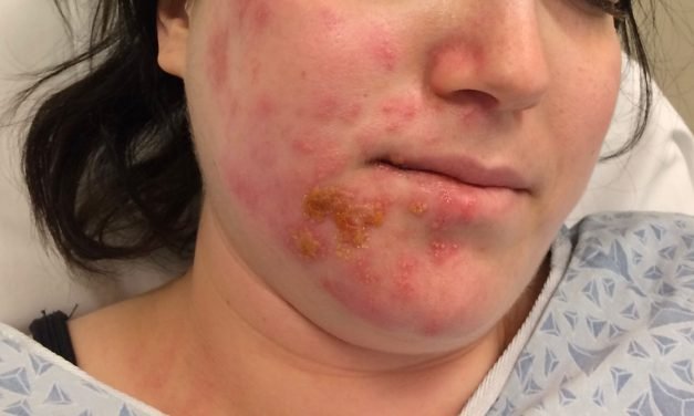 Symptoms and Causes of Ramsay Hunt Syndrome
