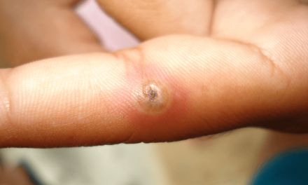 Symptoms and Treatment of Tungiasis