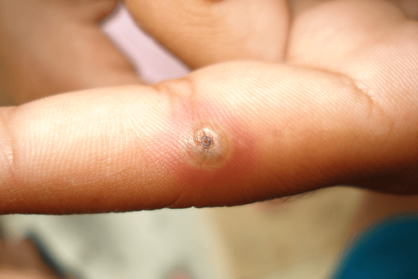 Symptoms and Treatment of Tungiasis
